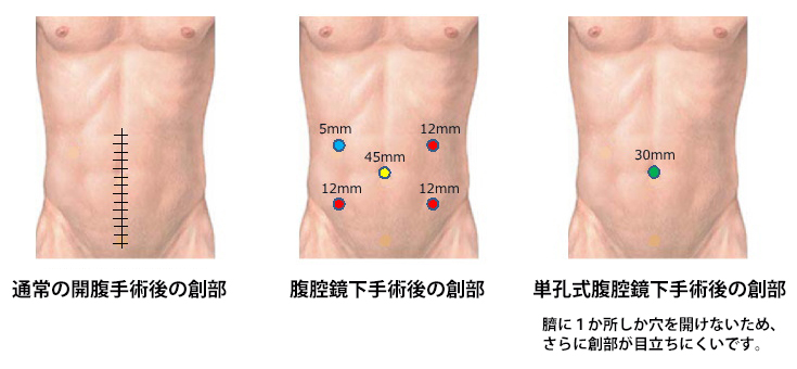 腹腔鏡下手術について