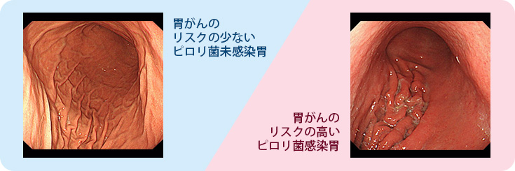 ピロリ菌